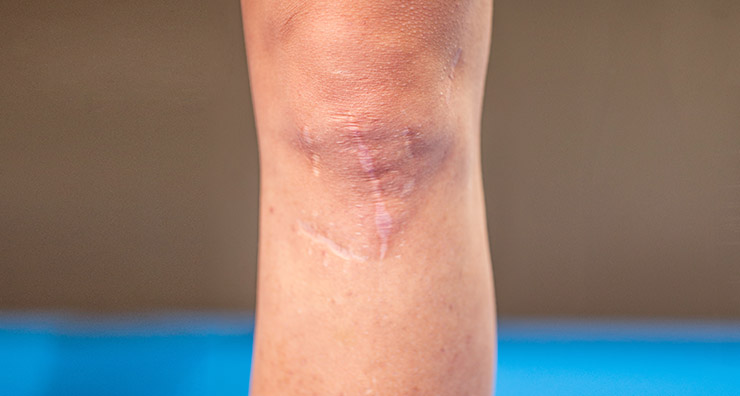 Scar Solutions