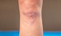 scar recovery gel skinmedica solutions