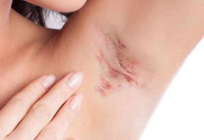Hidradenitis Suppurativa