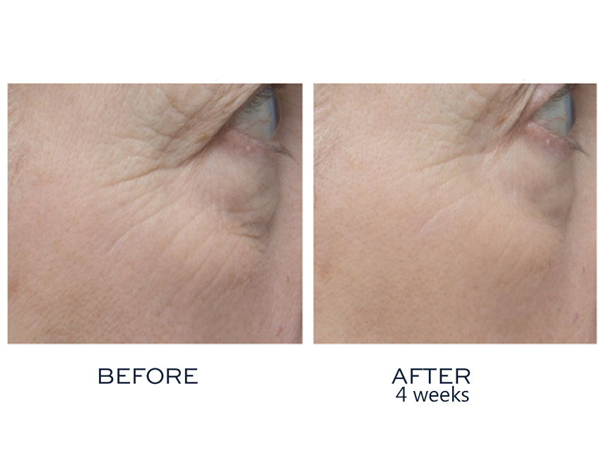 ivi collagen before and after ivi collagen before and after